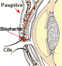 la blepharite, blefarite
